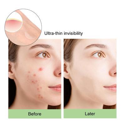 Pimple Patches - 72 Pcs