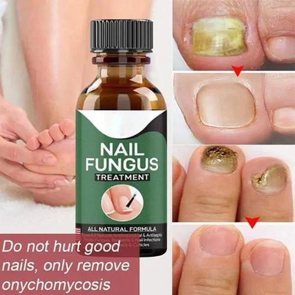 Effective Nail Fungus Treatment Serum - 1 Pc for Fast Relief