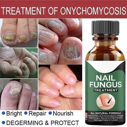 Effective Nail Fungus Treatment Serum - 1 Pc for Fast Relief