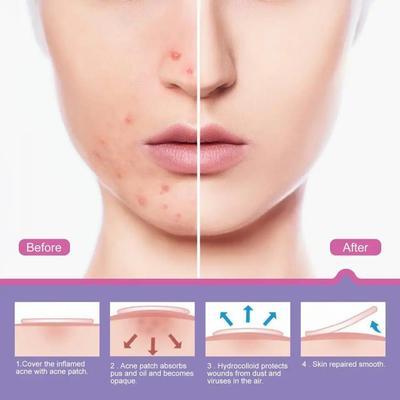 Pimple Patches - 72 Pcs